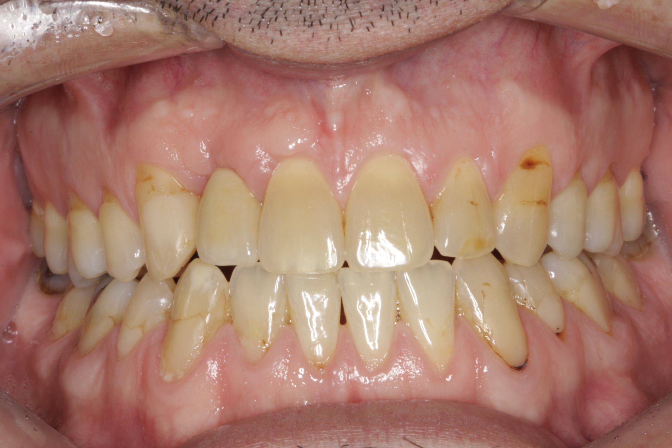 Dental Implants case study