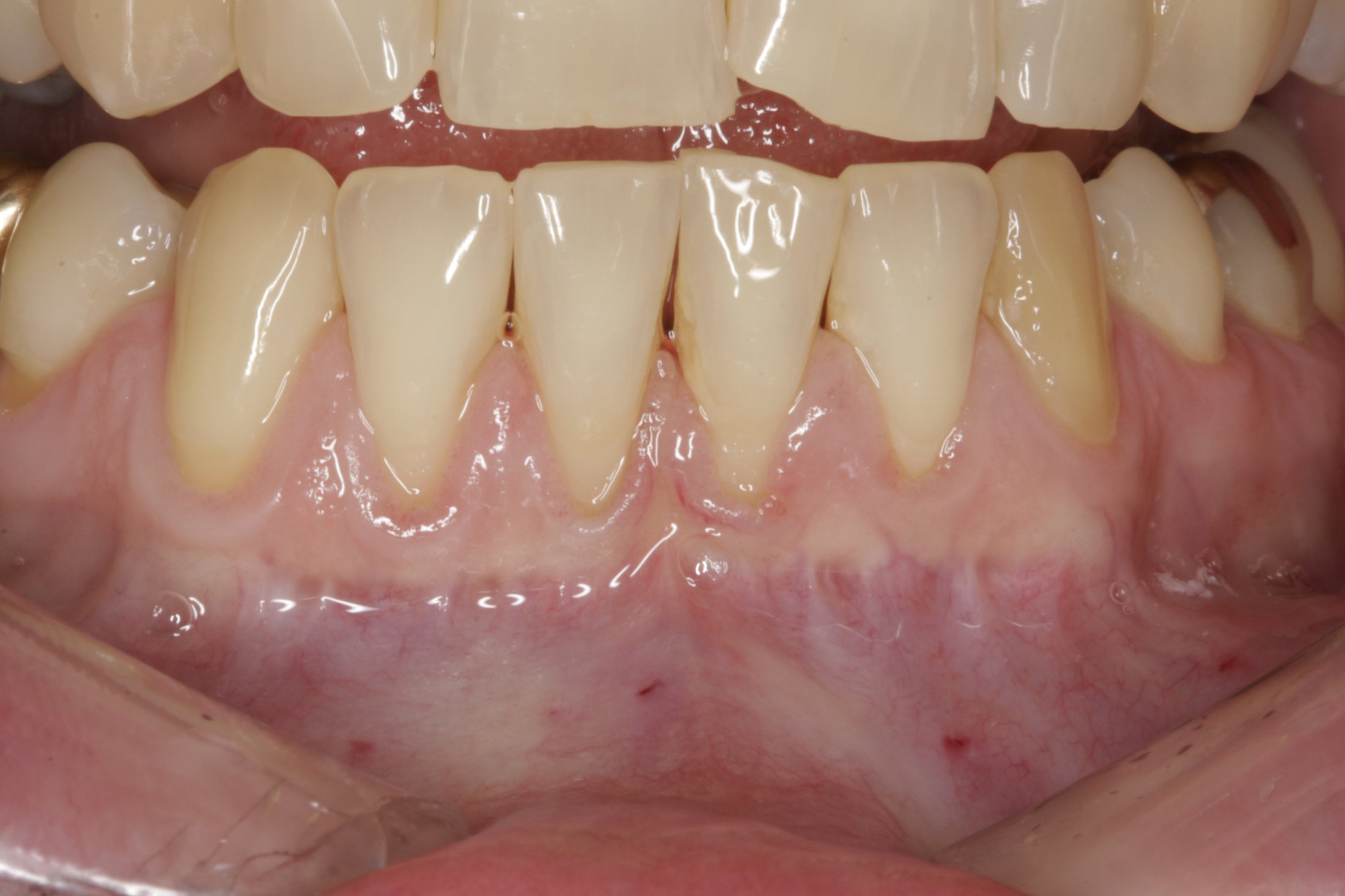 Connective Tissue Graft case study