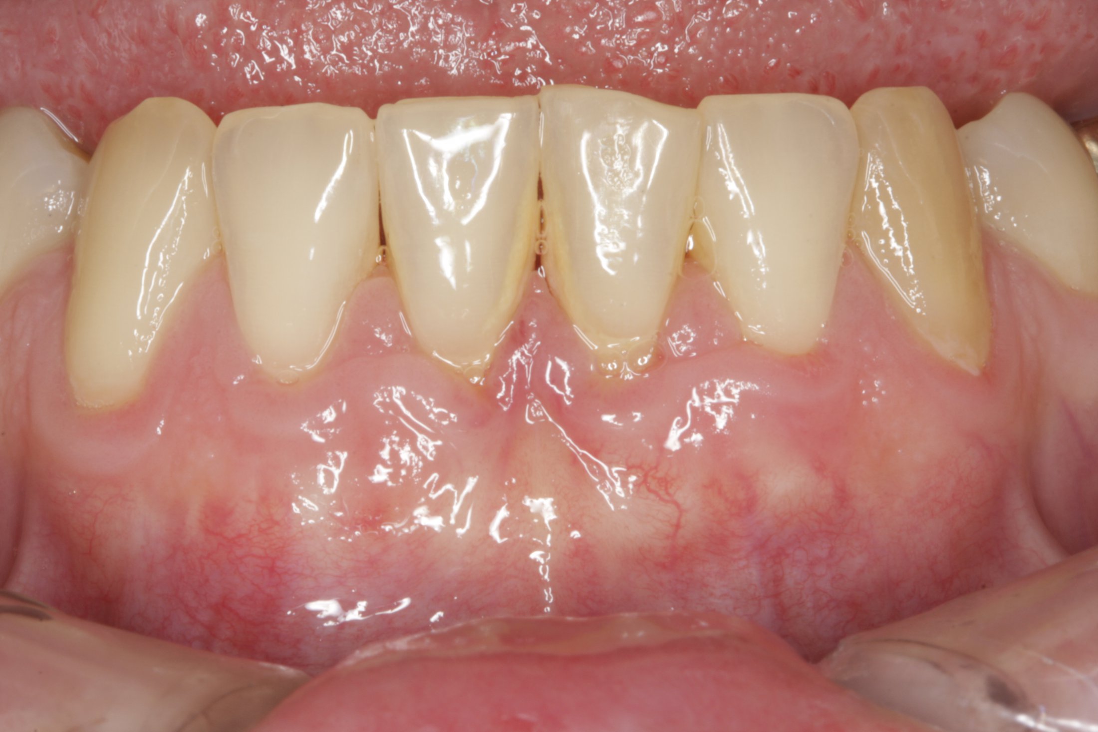 Connective Tissue Graft case study