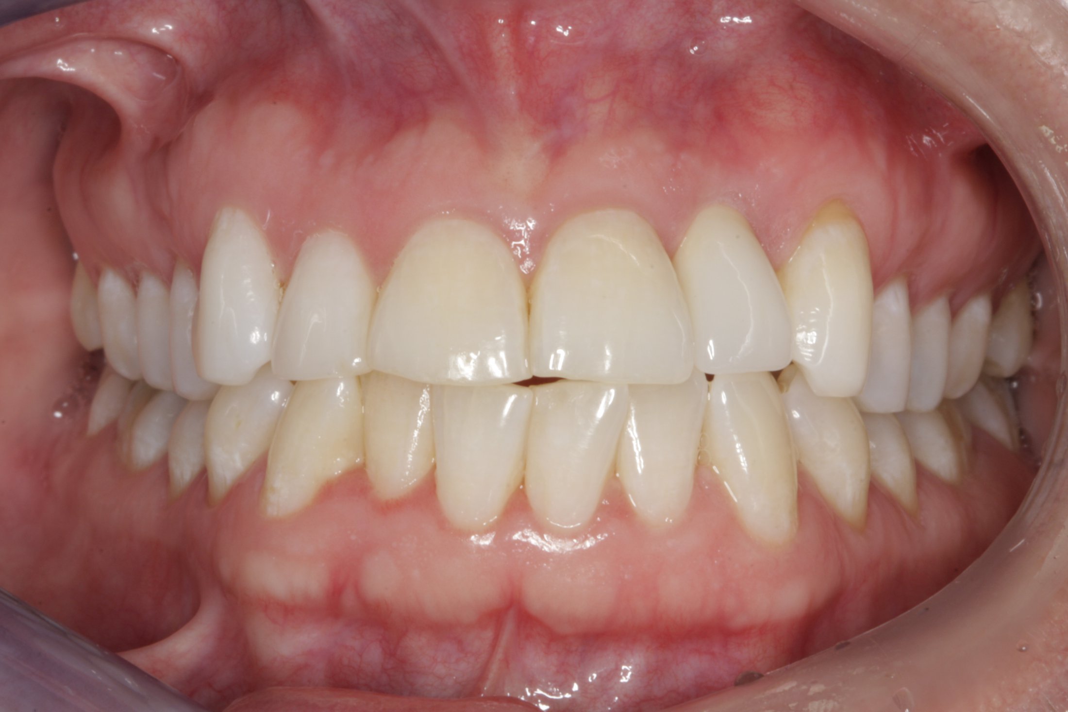 Dental Implants case study