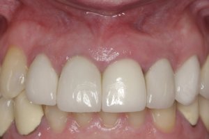 Dental Implants case study