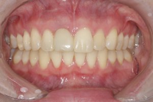 Dental Implants case study