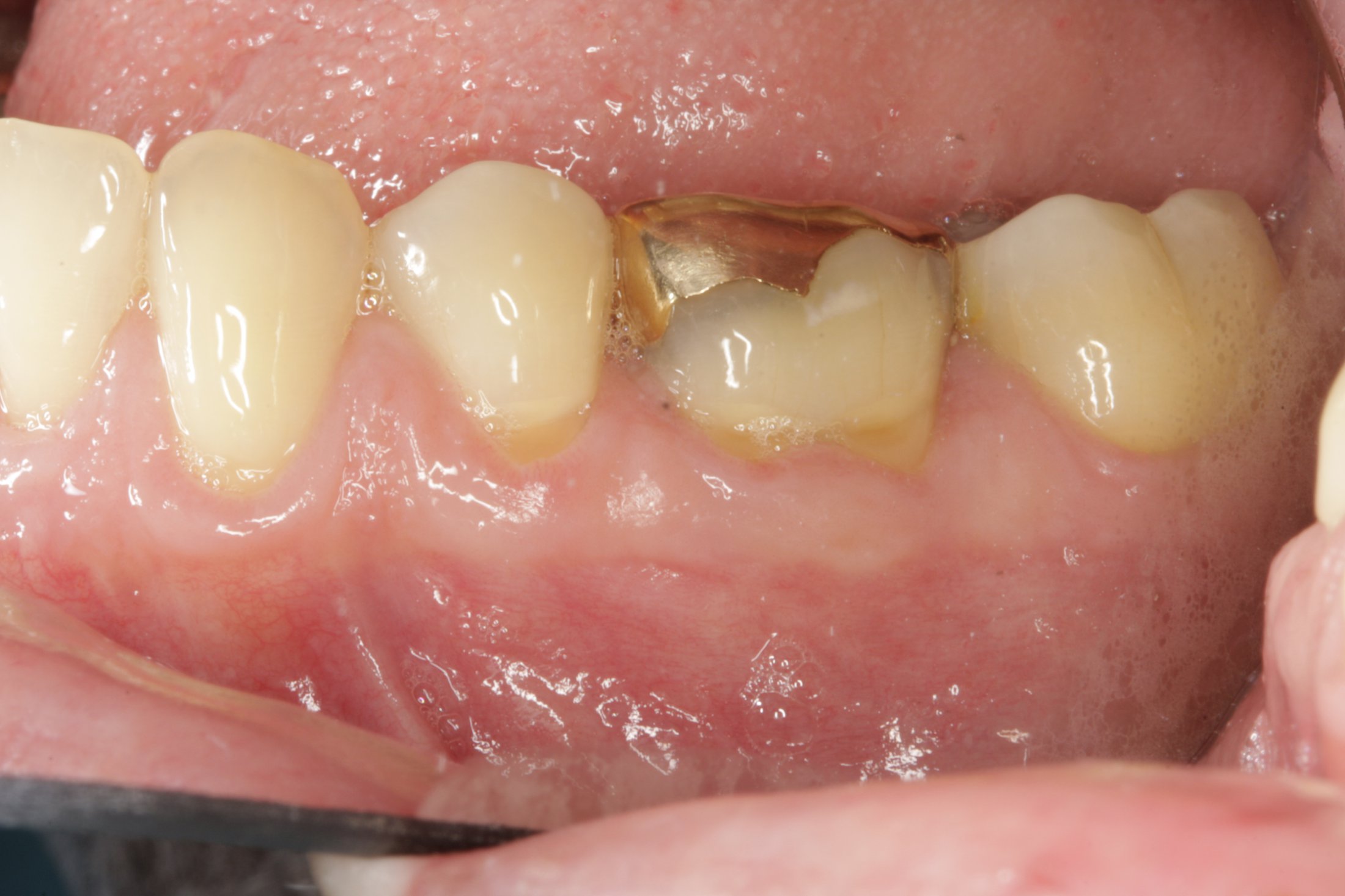 Connective Tissue Graft case study