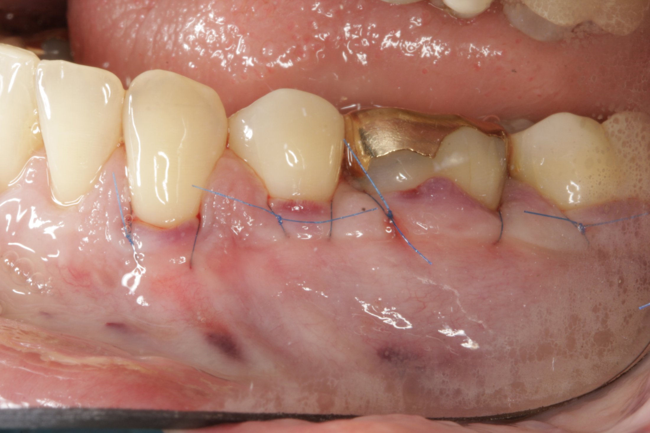 Connective Tissue Graft case study