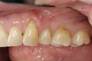 Allograft case study