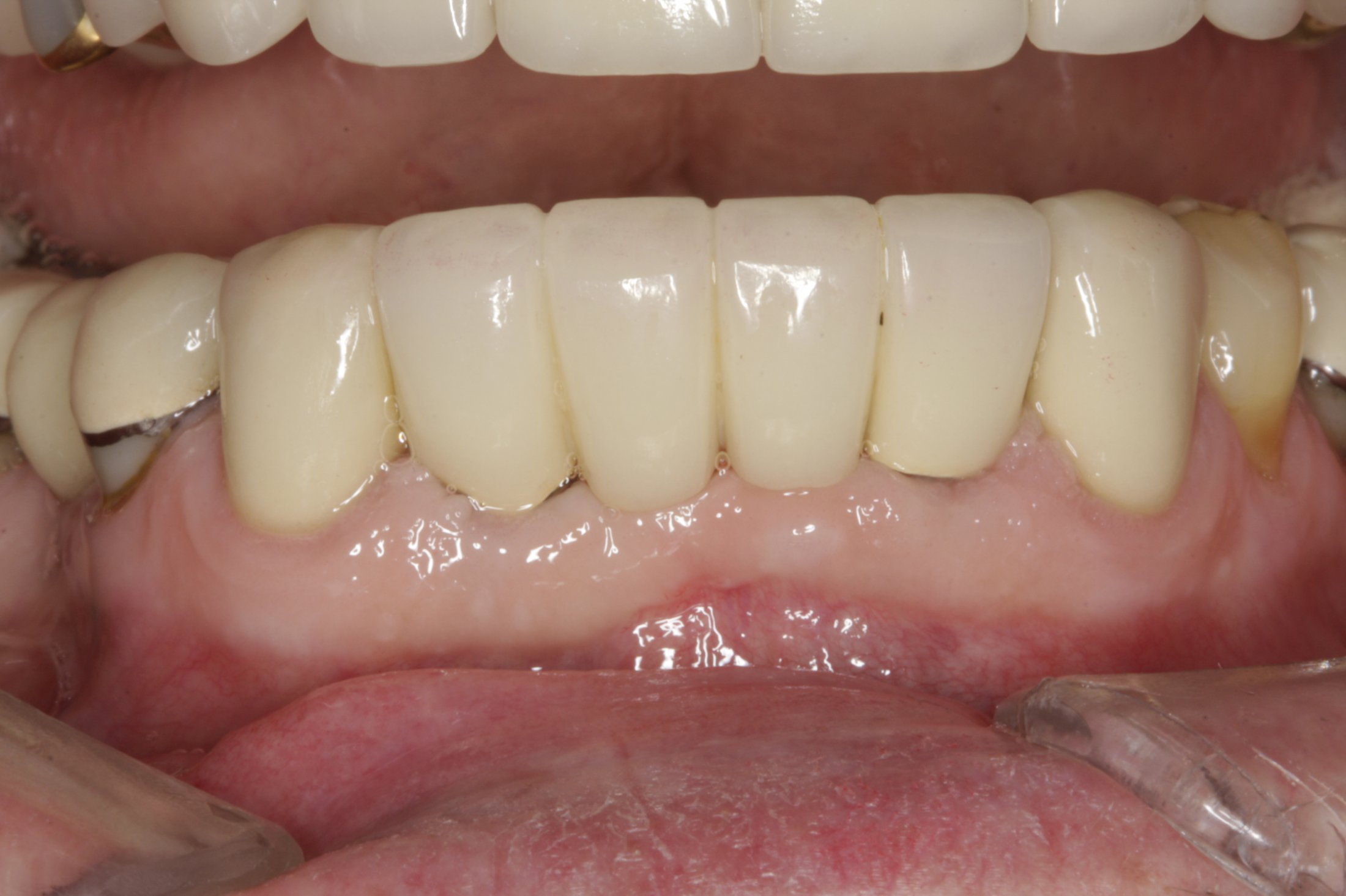 Dental Implants case study