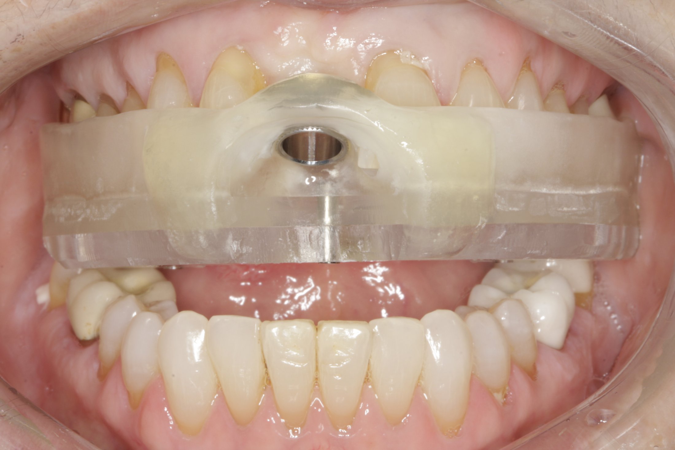 Guided Surgery case study
