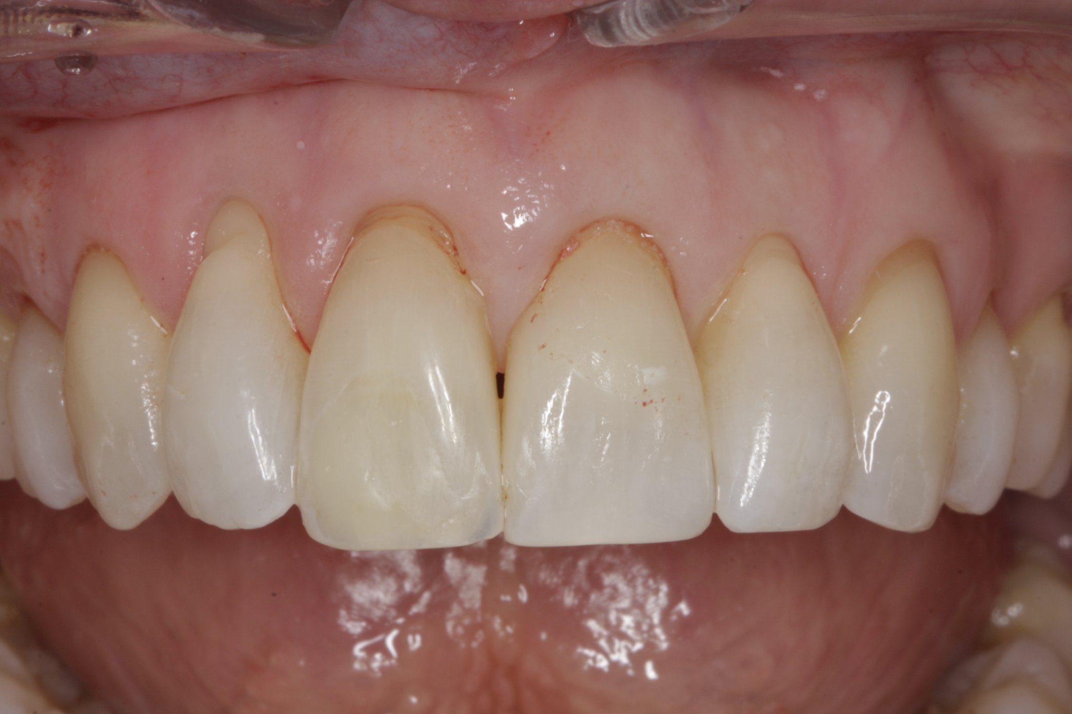 Allograft case study