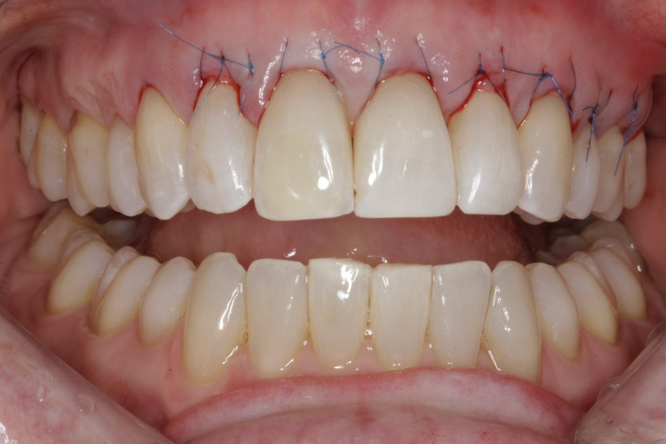 Allograft case study