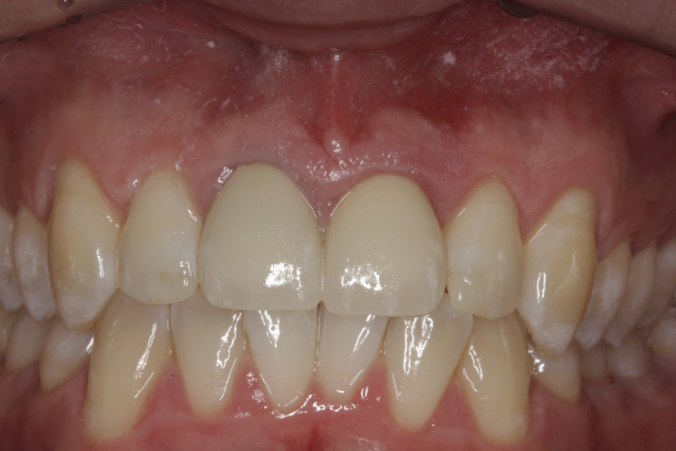 Dental Implants case study