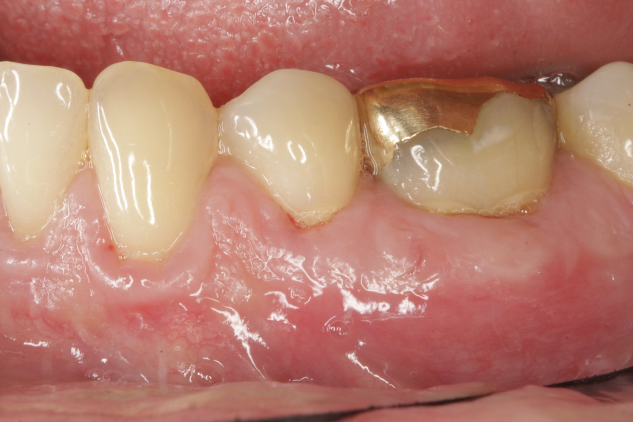 Connective Tissue Graft case study