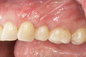 Allograft case study