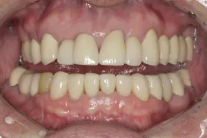 Dental Implants case study