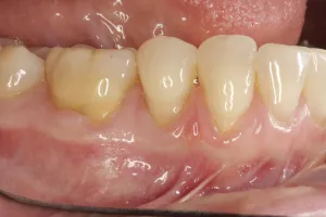 Allograft case study