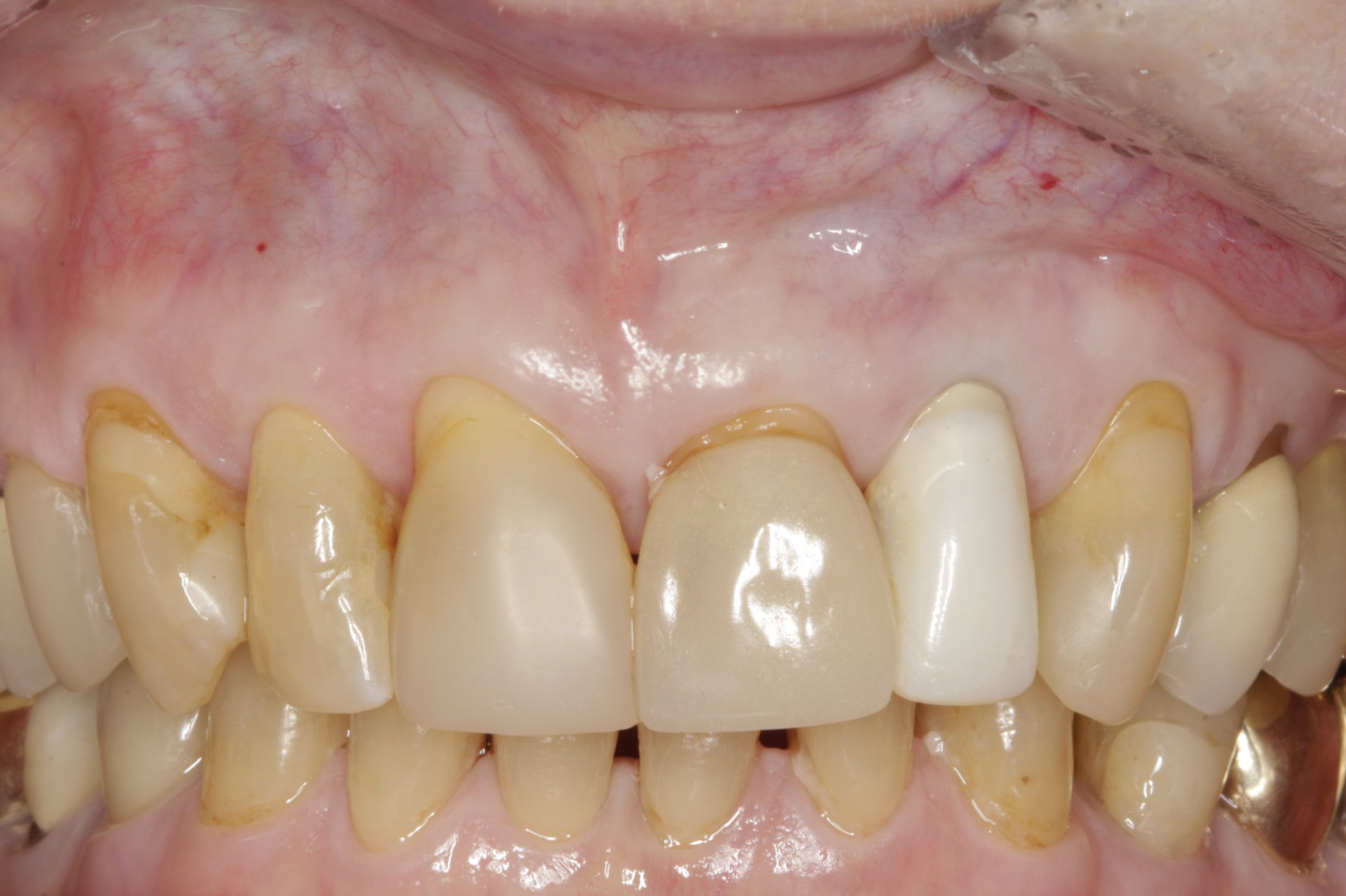 Dental Implants case study