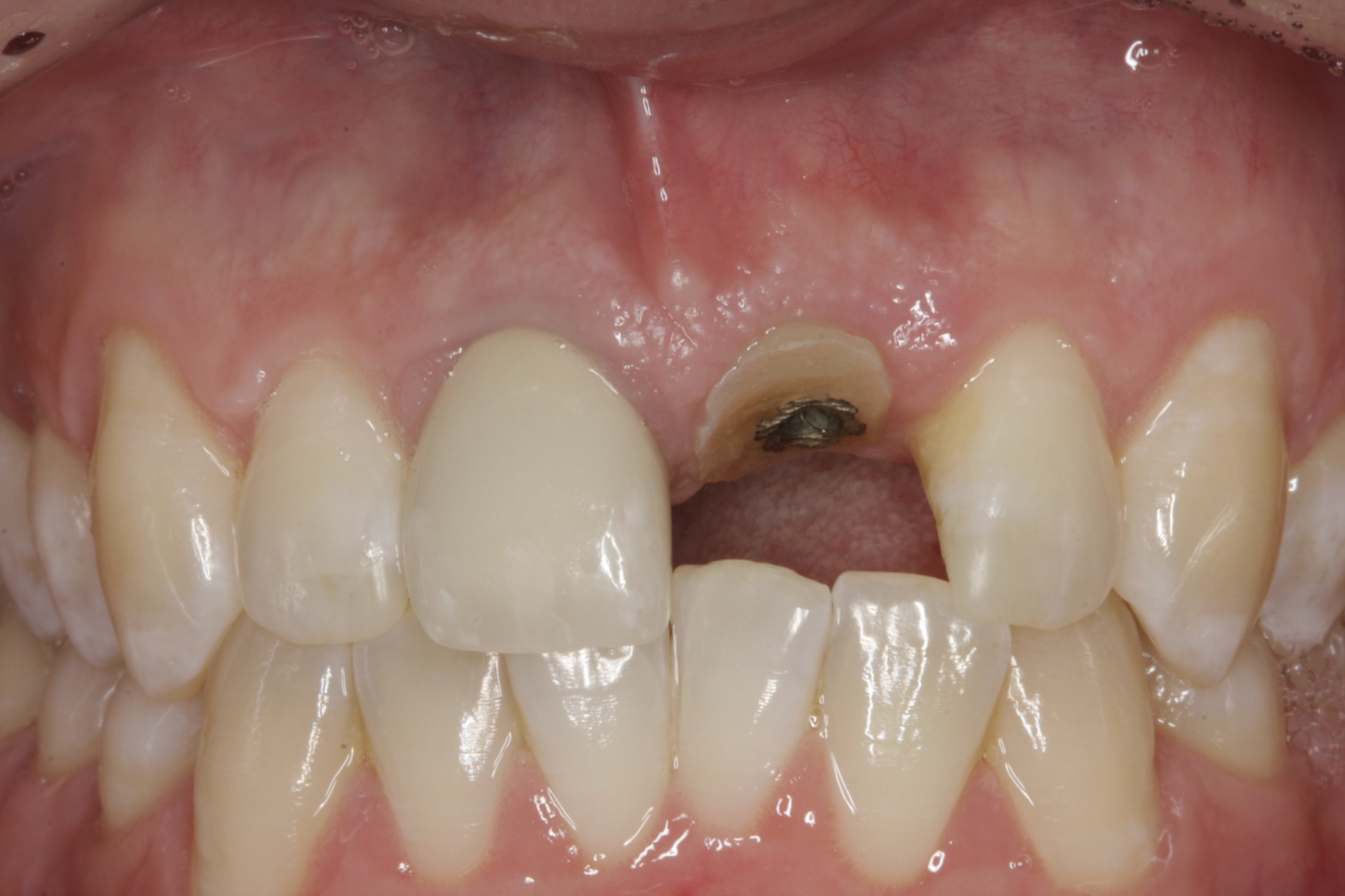 Dental Implants case study