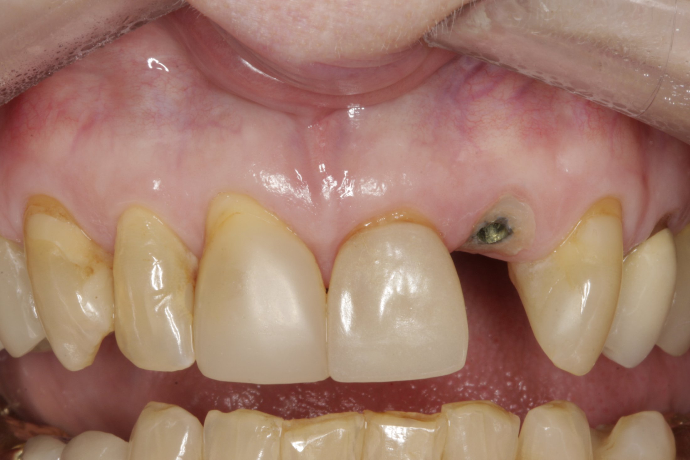 Dental Implants case study