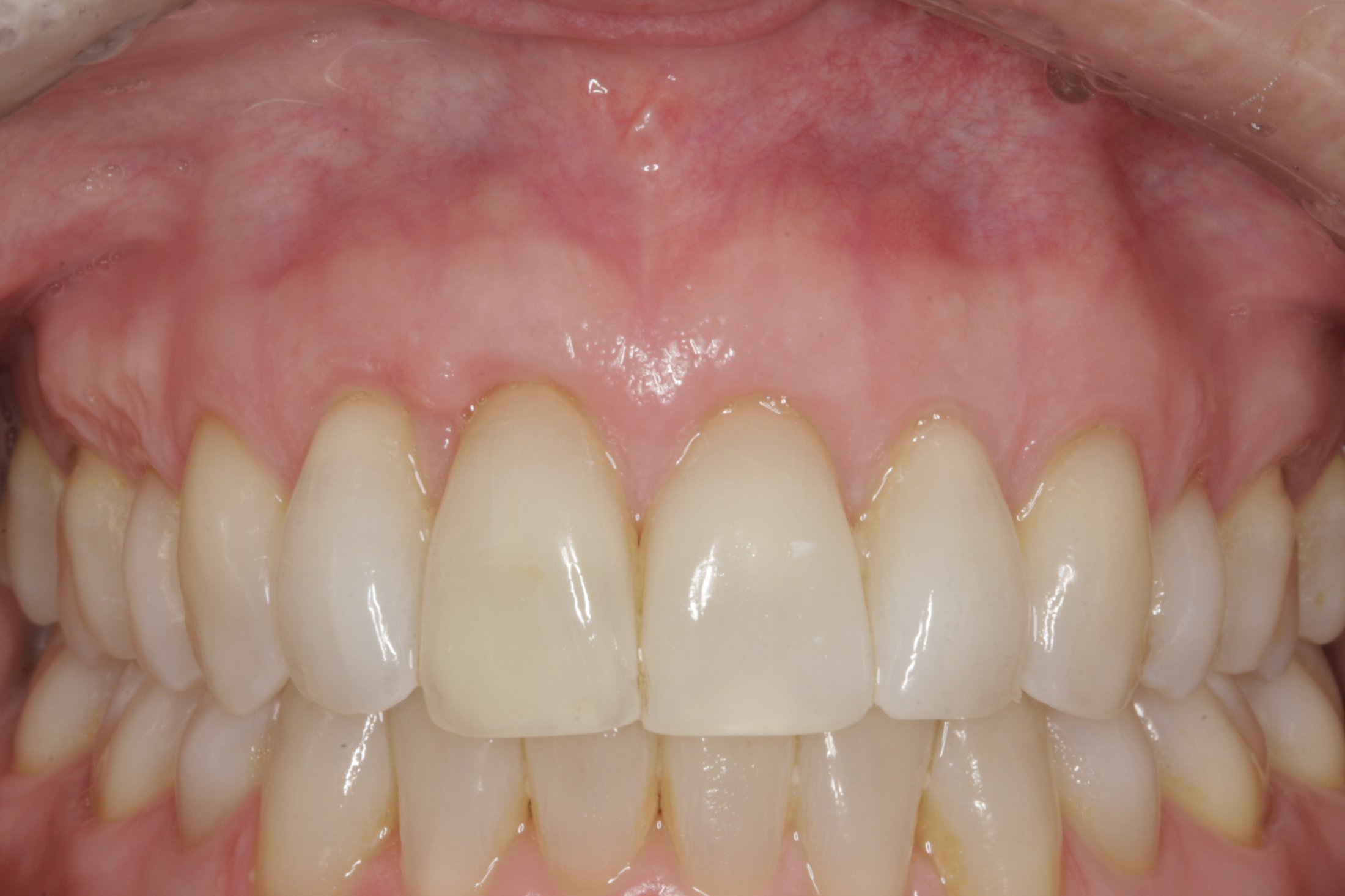 Allograft case study