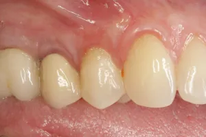 Allograft case study