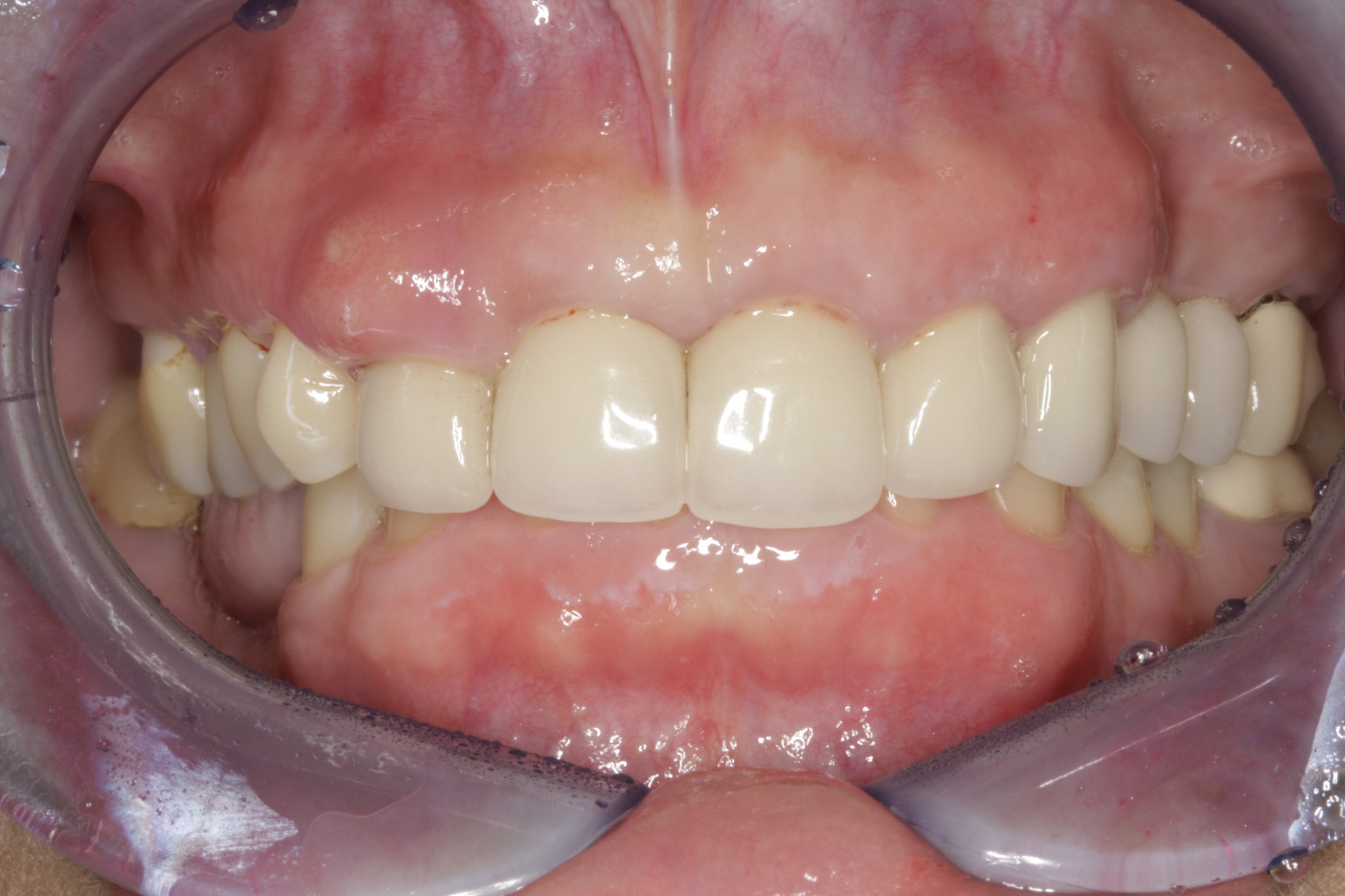 Dental Implants case study