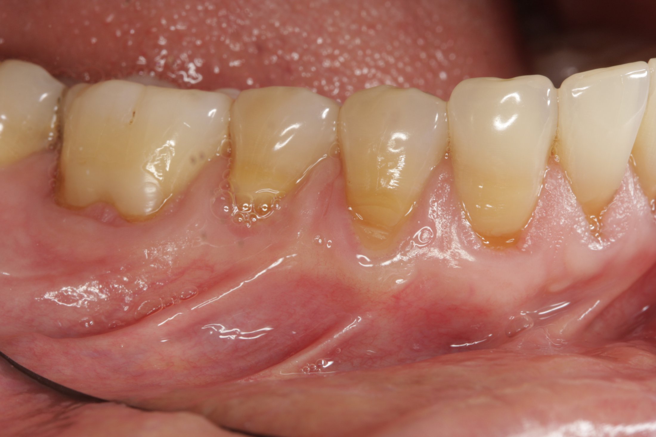 Allograft case study