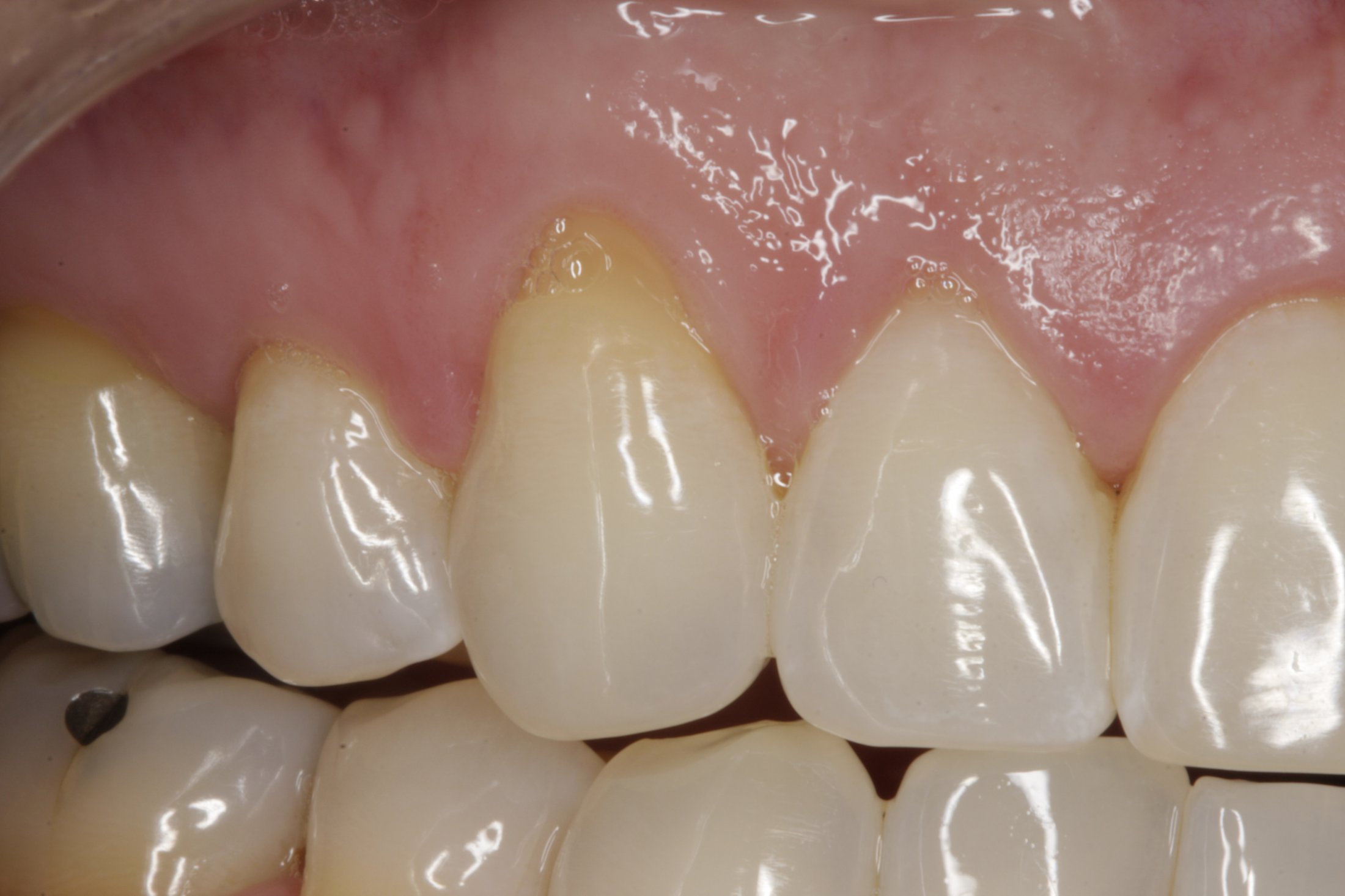 Allograft case study