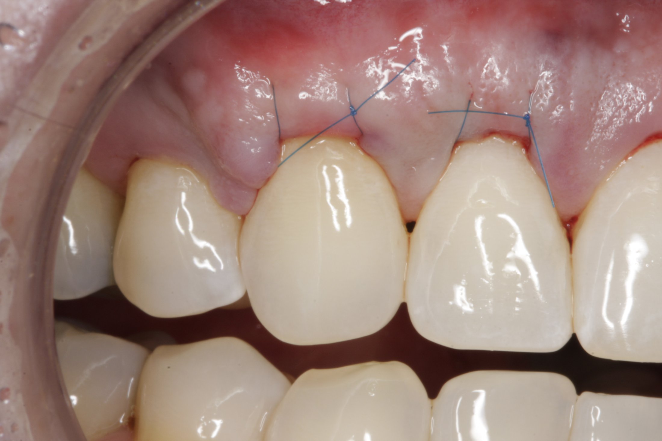 Allograft case study