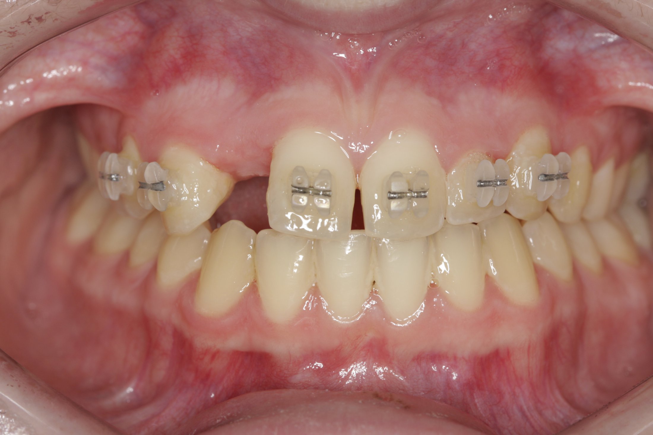 Dental Implants case study
