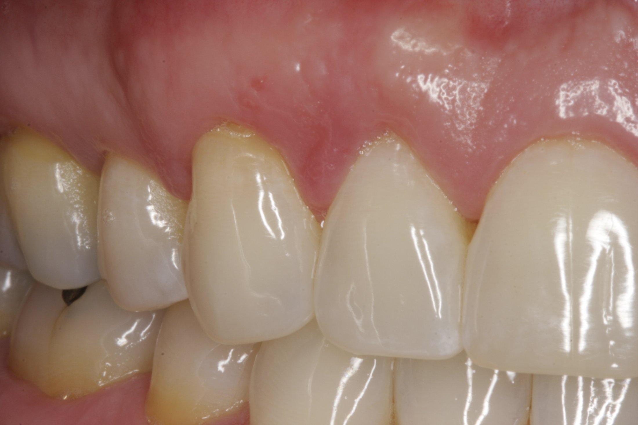 Allograft case study