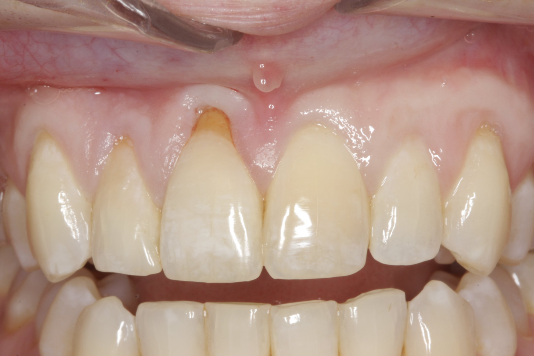 Allograft case study