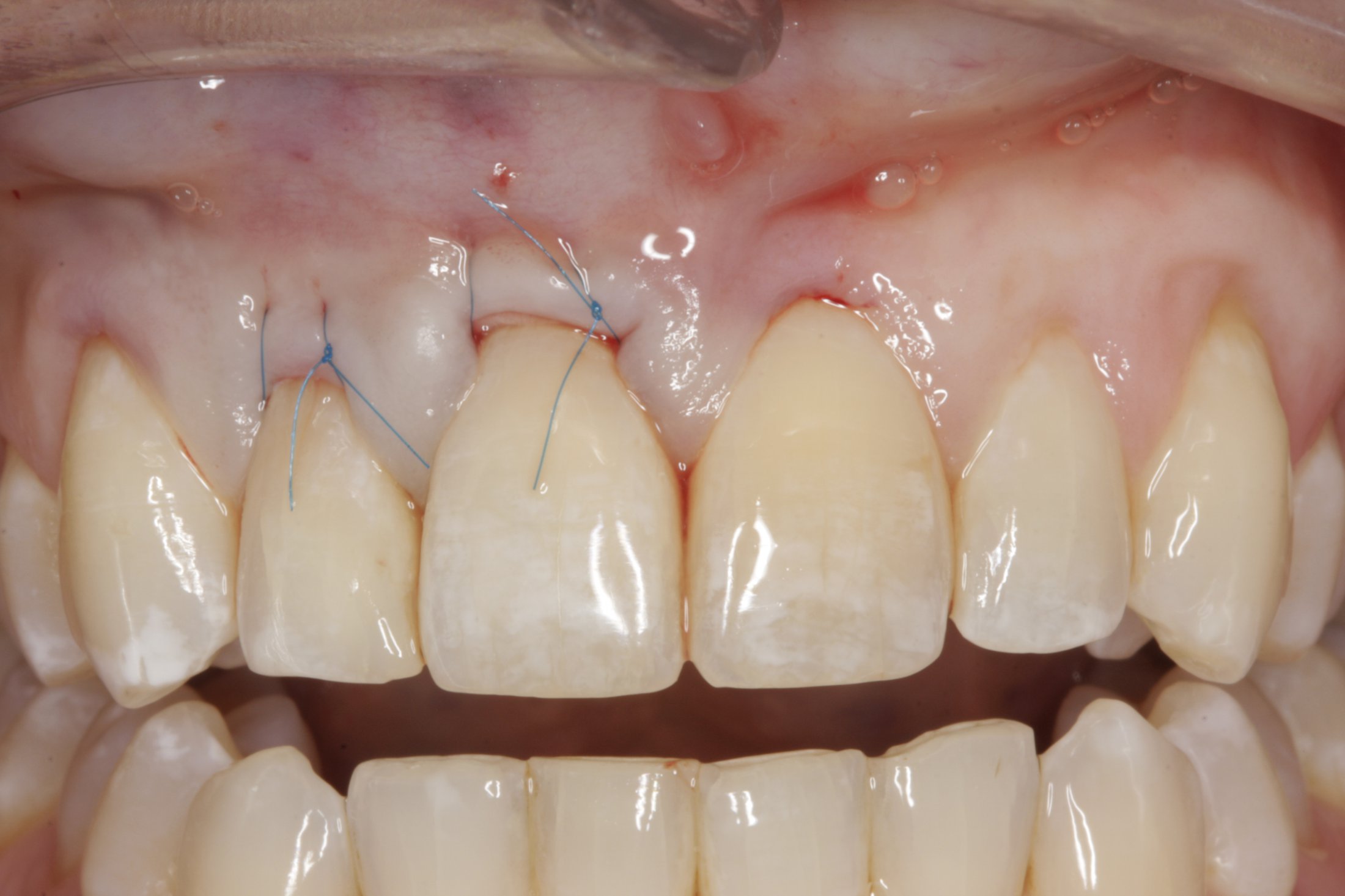 Allograft case study