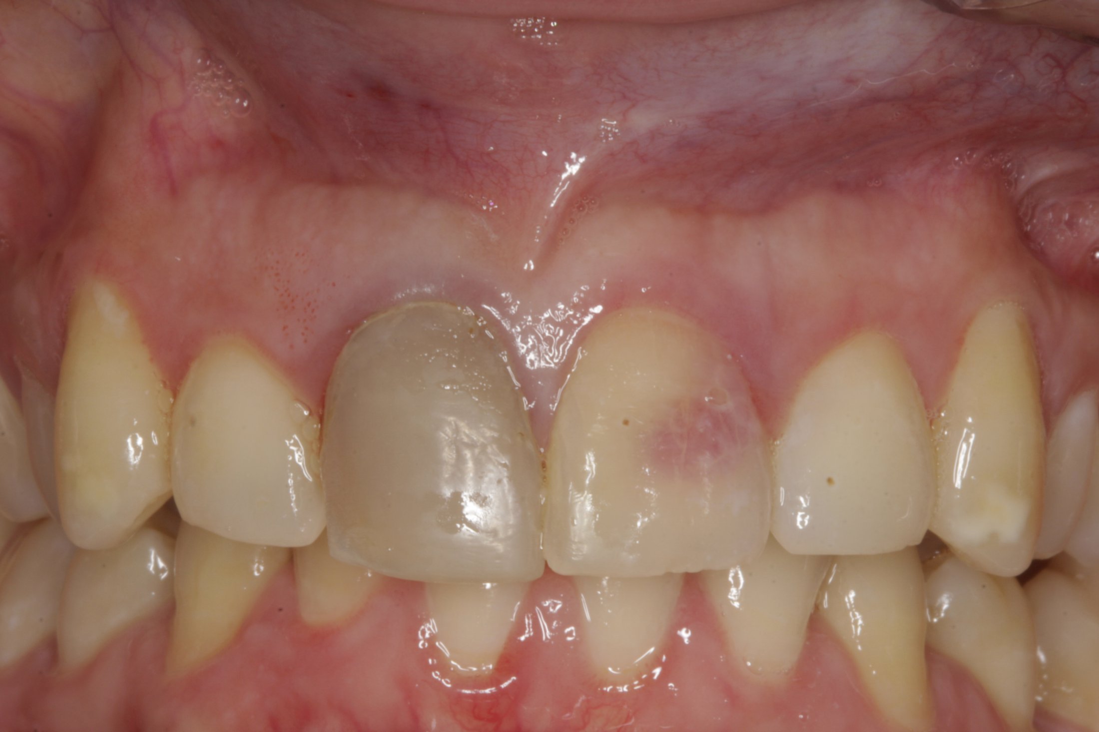 Dental Implants case study