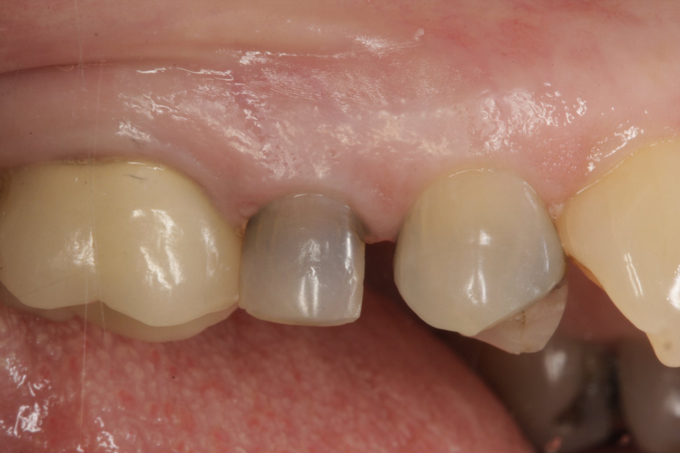 Dental Implants case study