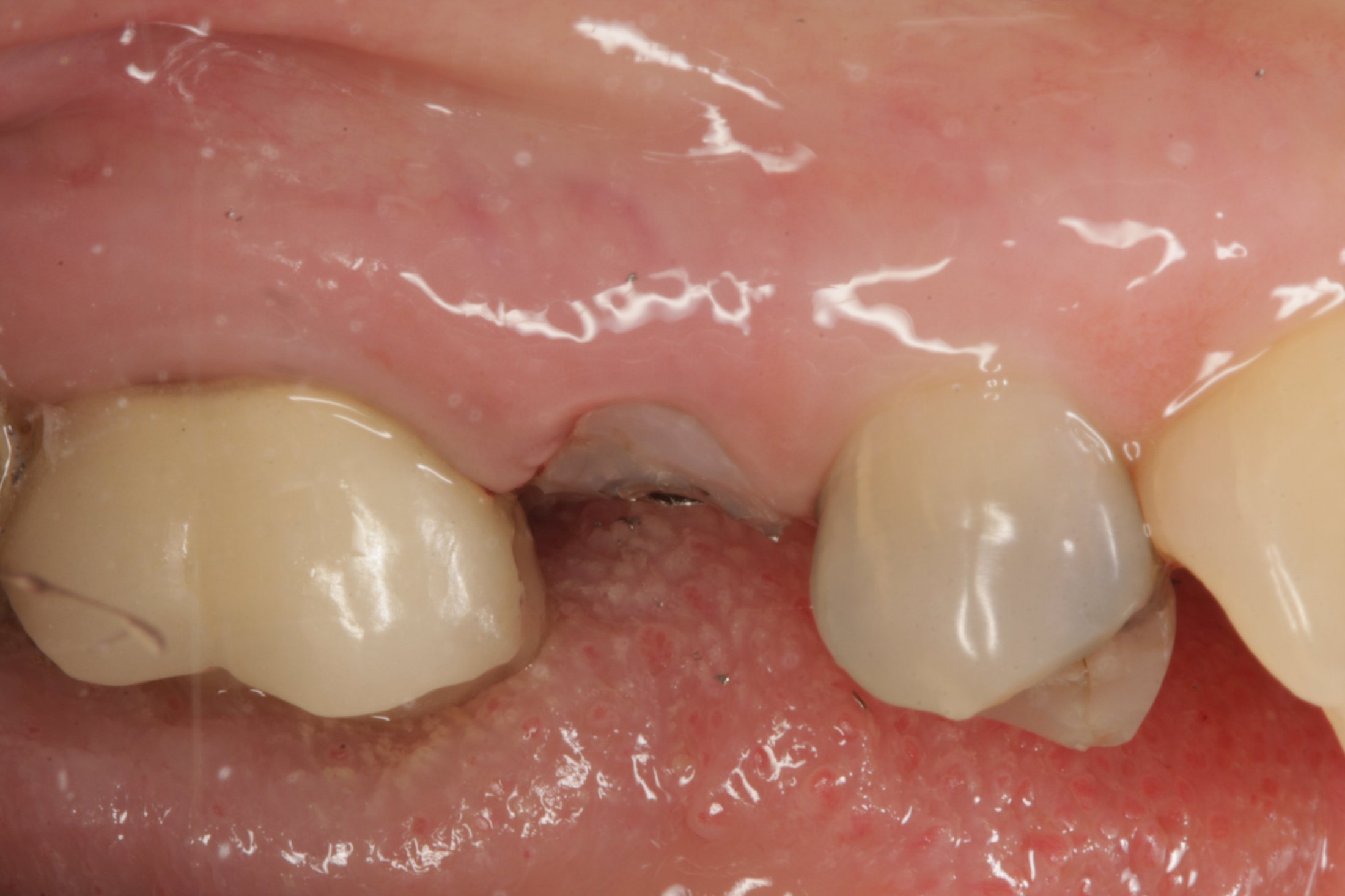 Dental Implants case study