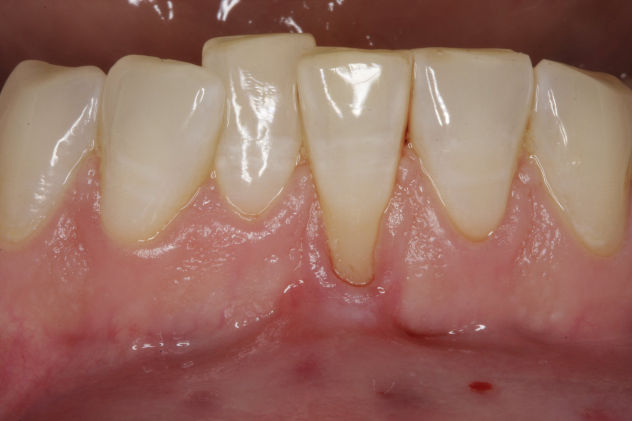 Connective Tissue Graft case study
