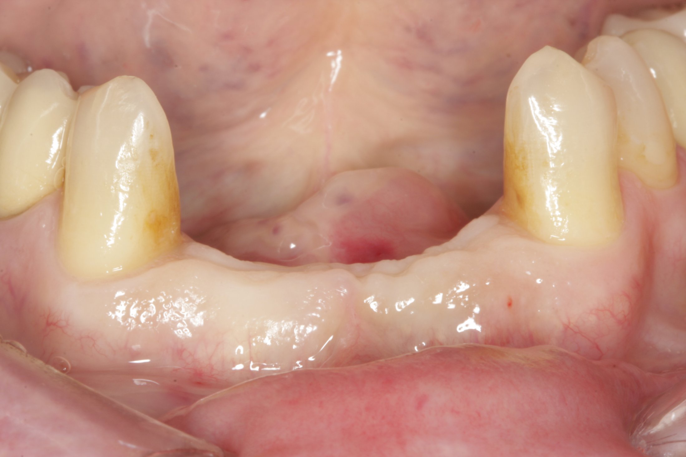 Dental Implants case study