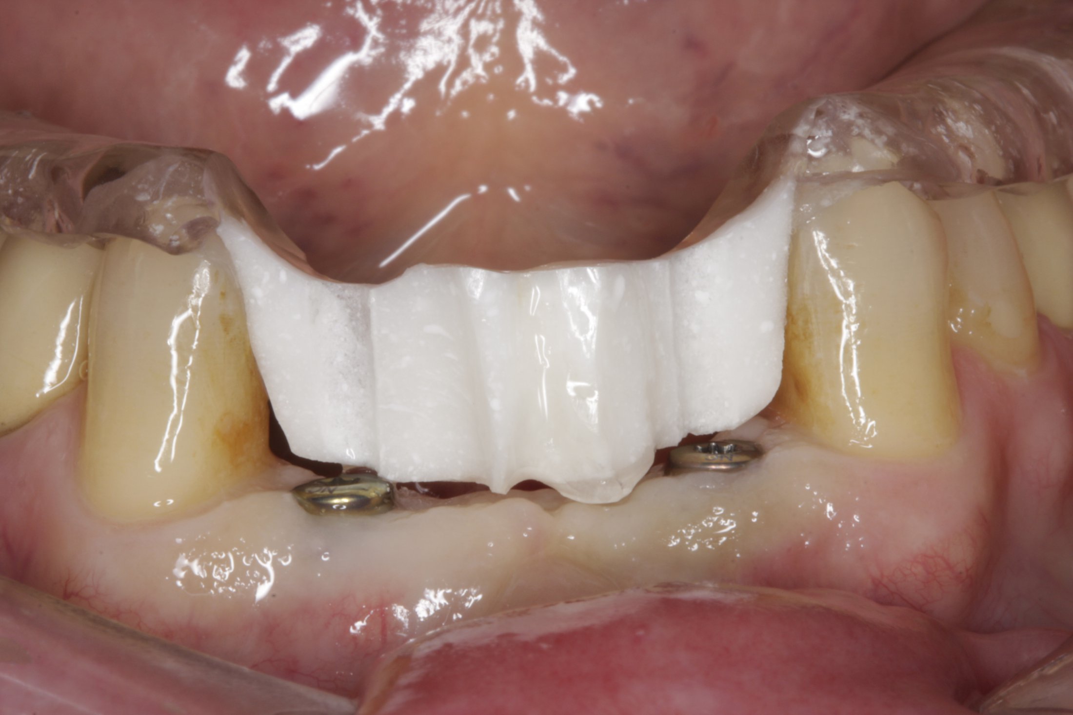 Dental Implants case study