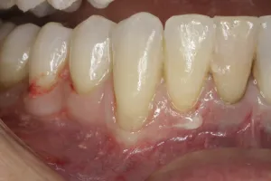 Allograft case study