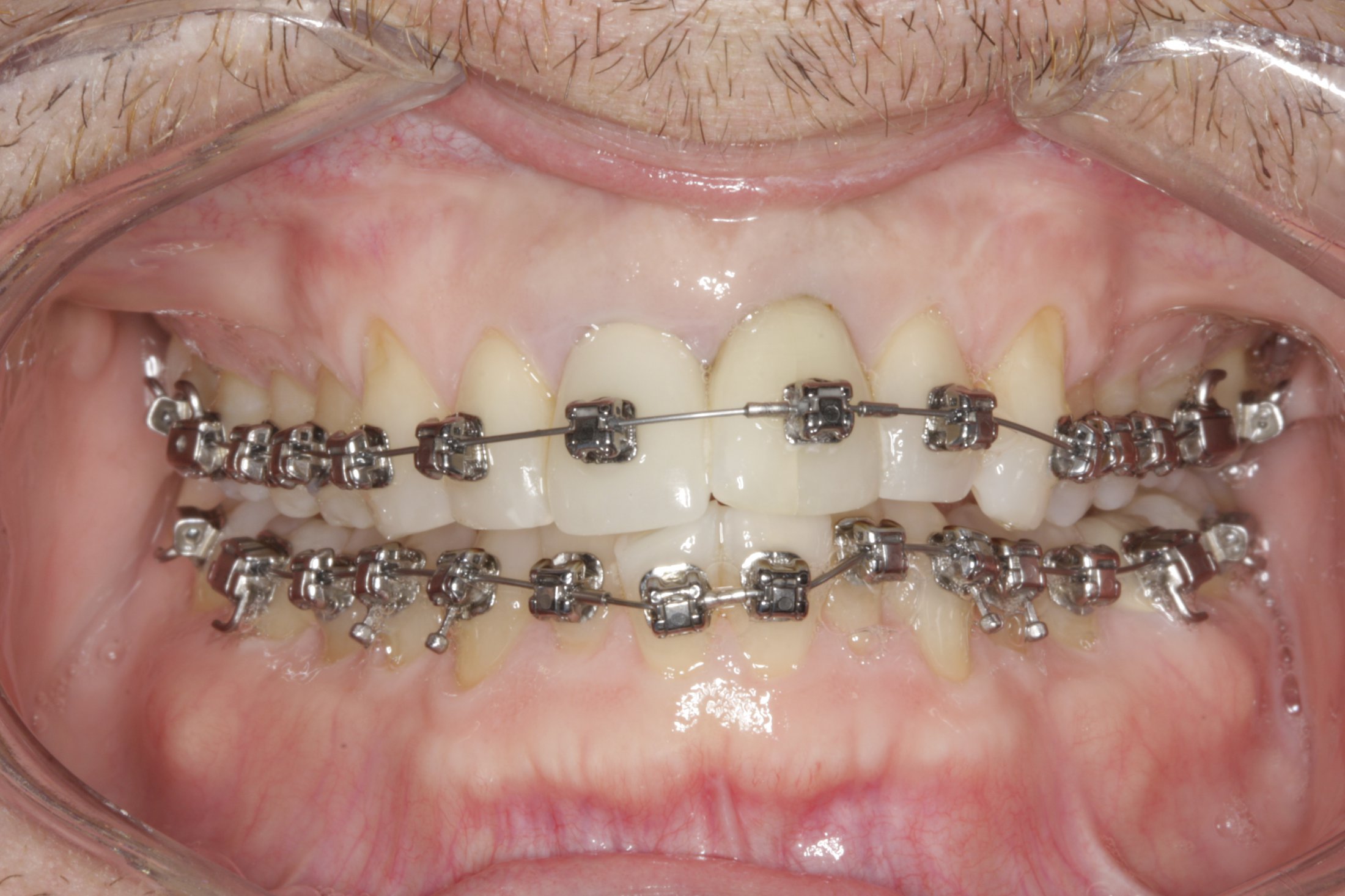 Periodontally accelerated osteogenic case study