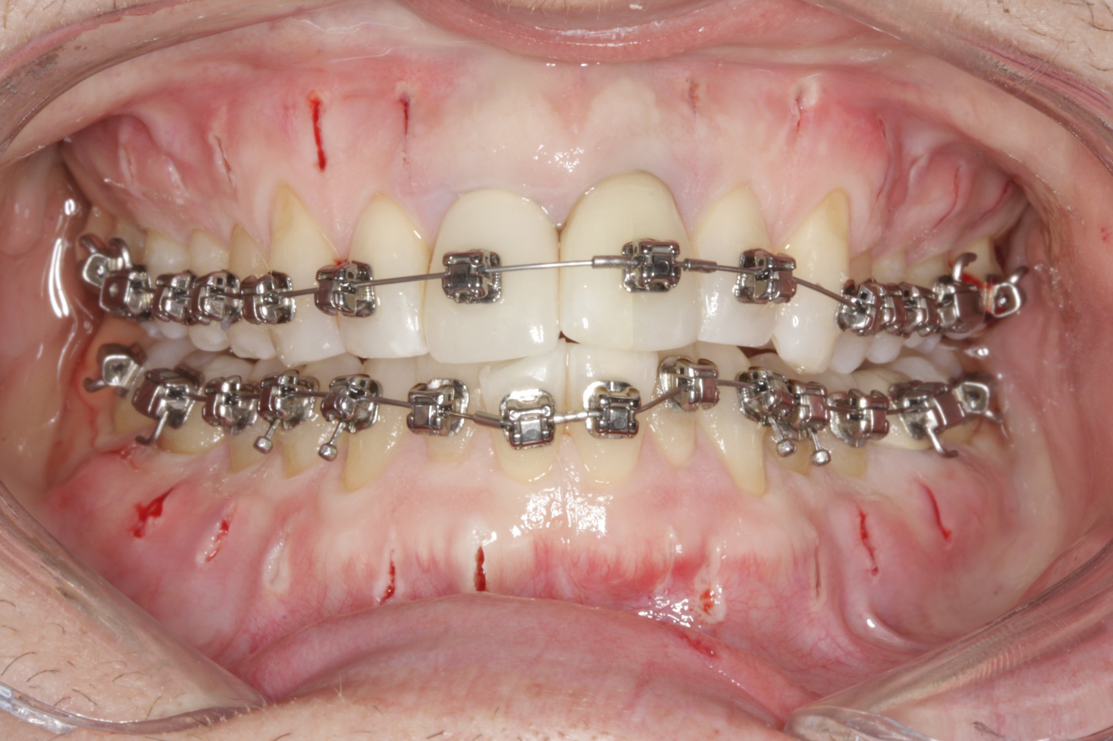 Periodontally accelerated osteogenic case study