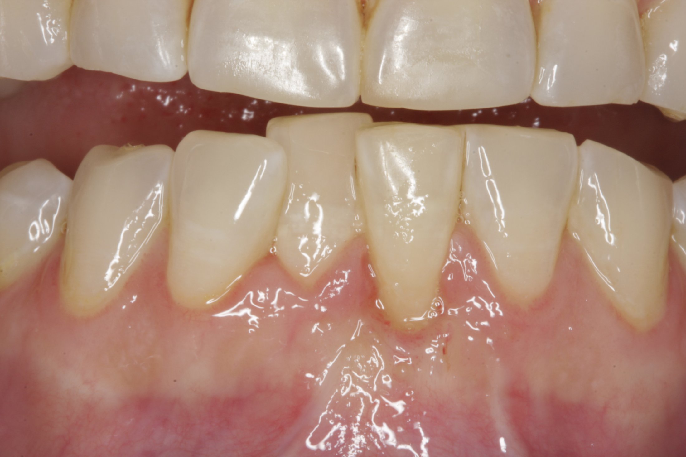 Connective Tissue Graft case study