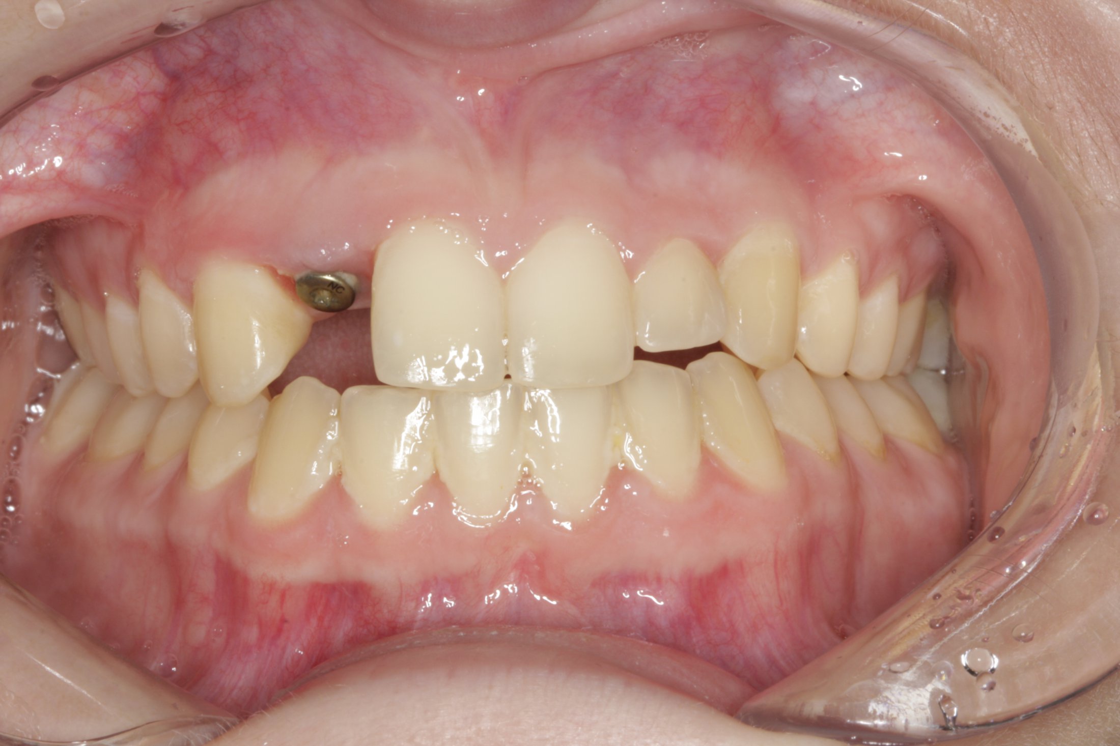 Dental Implants case study
