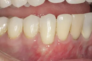 Allograft case study