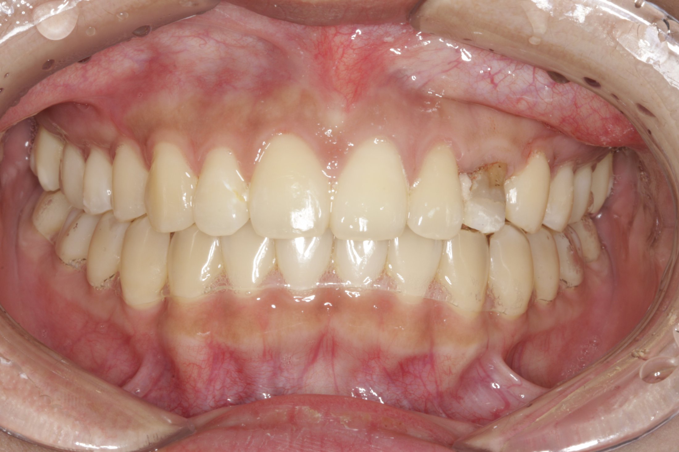 Dental Implants case study