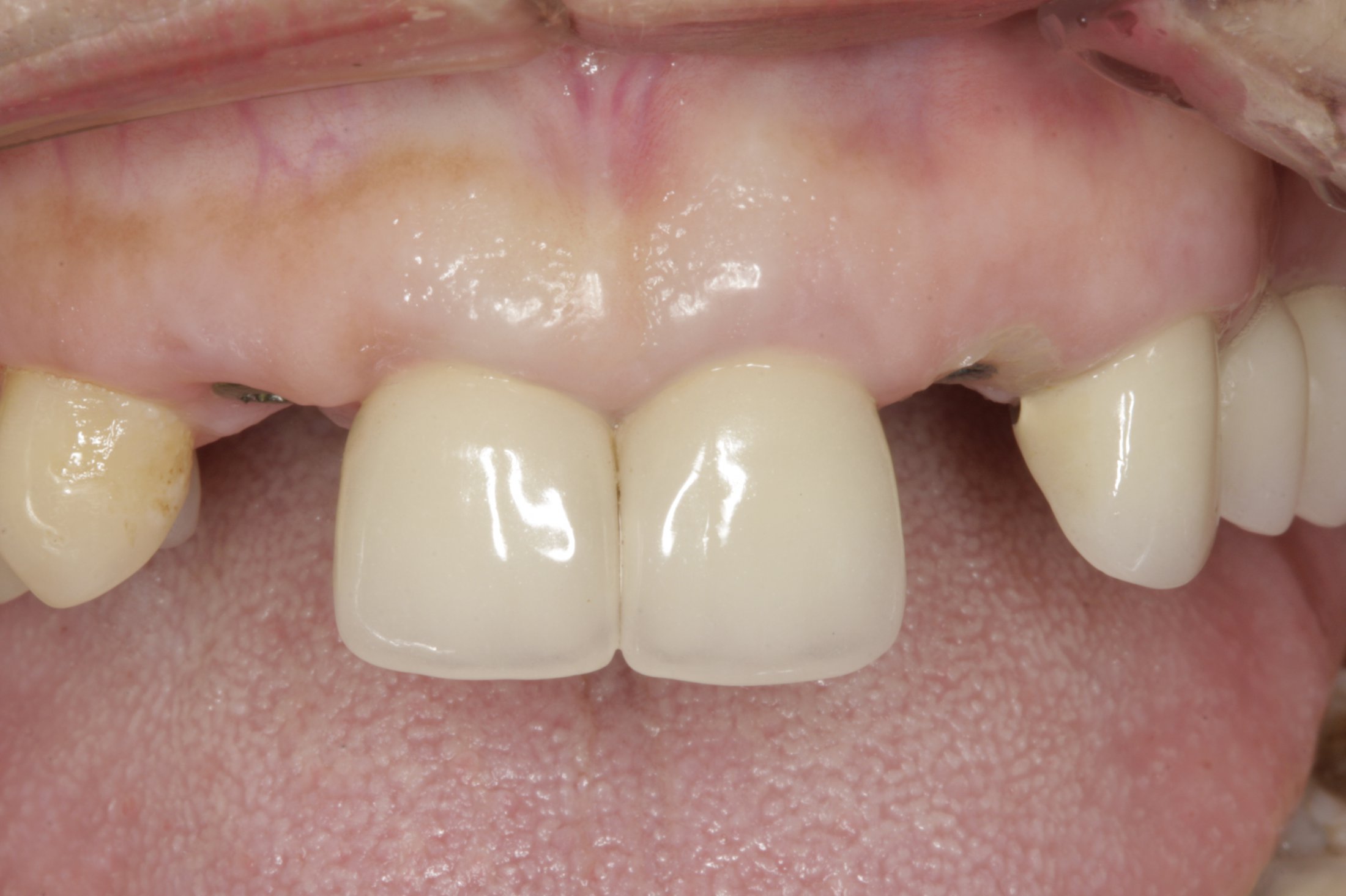 Dental Implants case study