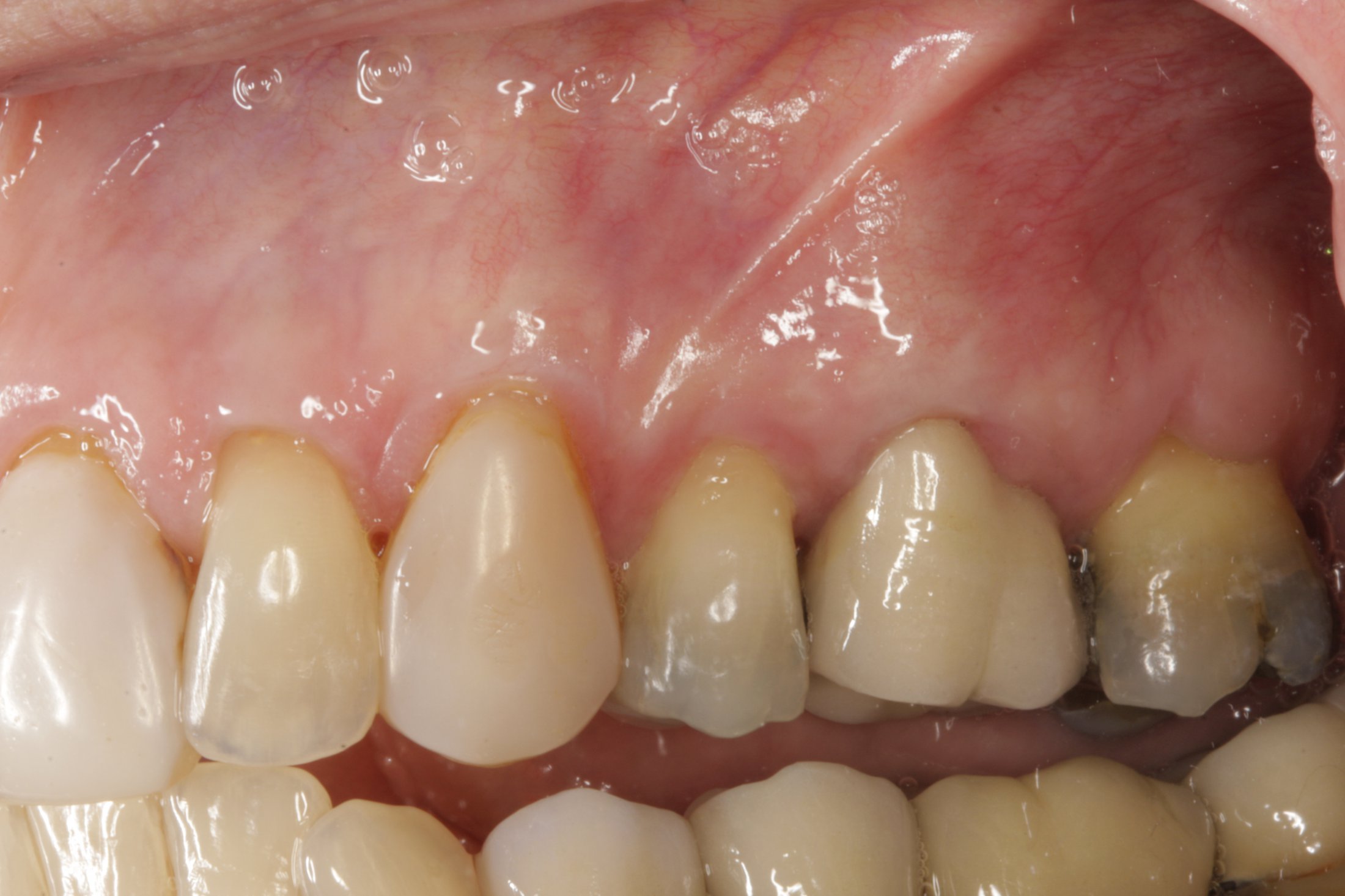 Connective Tissue Graft case study