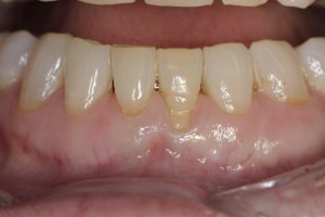 Connective Tissue Graft case study