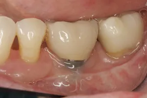 Connective Tissue Graft case study
