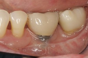 Connective Tissue Graft case study