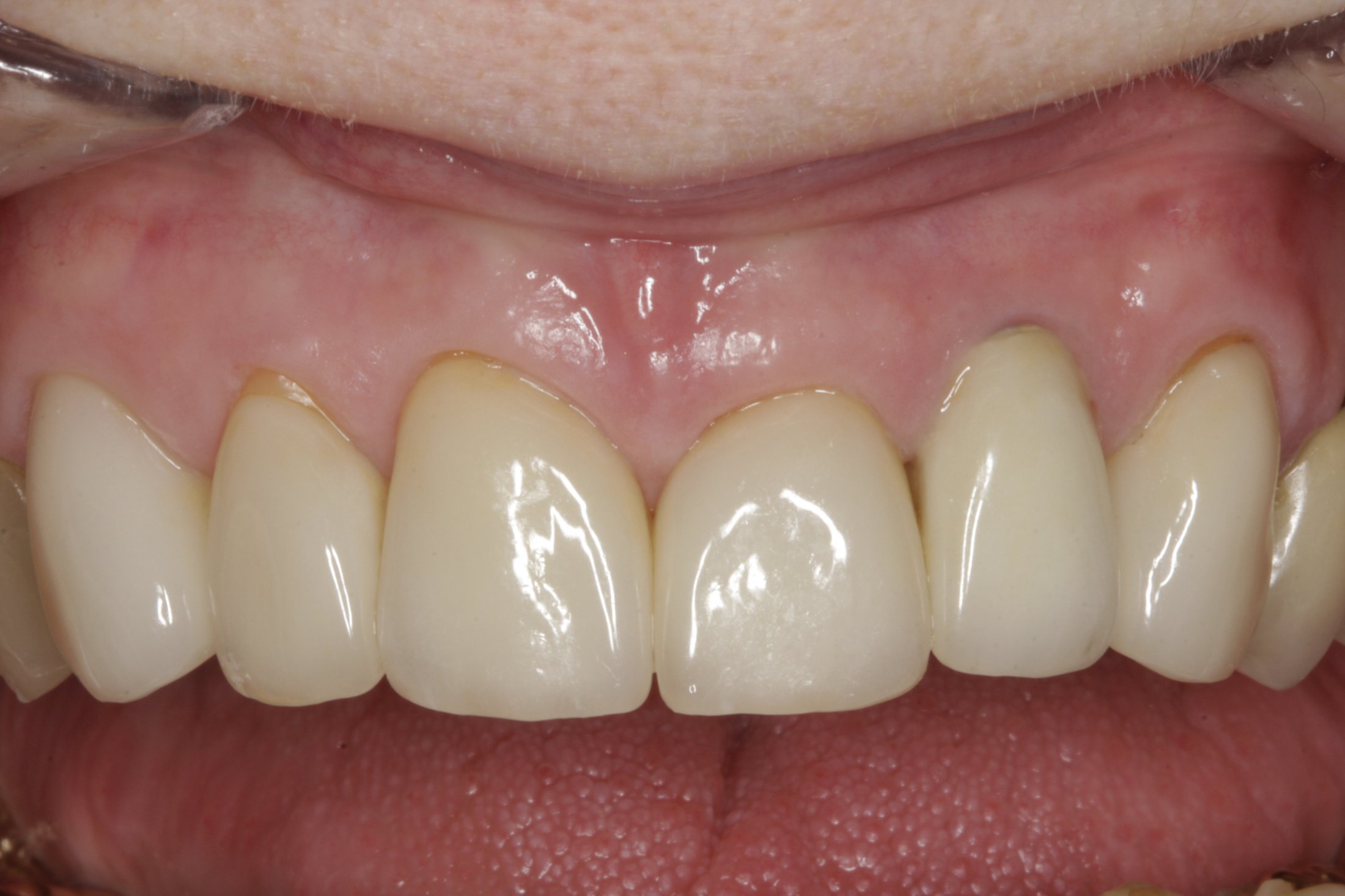 Dental Implants case study